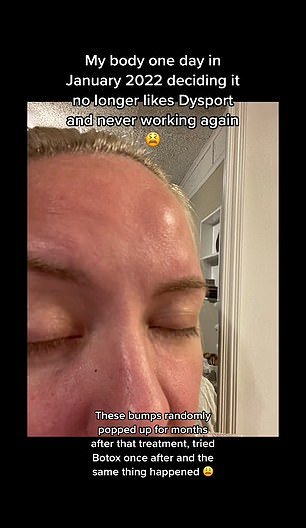 After using Botox alternative Dysport for about eight years, Holly Brooke shared on TikTok that she started getting lumps on her forehead