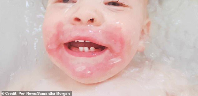 A toddler screamed in pain after a brush containing 'Britain's most dangerous plant' left him so blistered that his skin had to be removed
