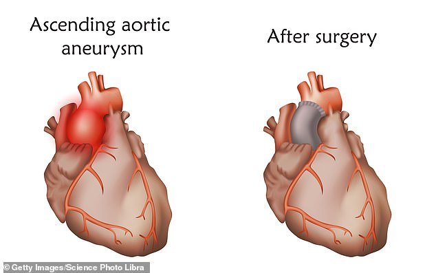 If you have an ascending aortic aneurysm that grows so large that treatment is needed, doctors sometimes implant surgical mesh around the vessel to support it.
