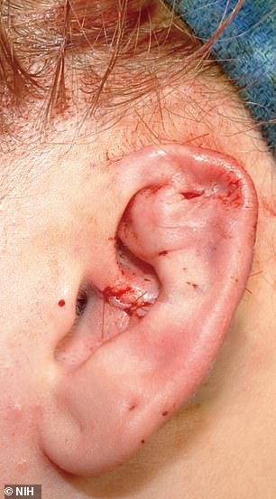 The ear of the 17-year-old patient after she had undergone reconstructive surgery, following a severe cartilage infection