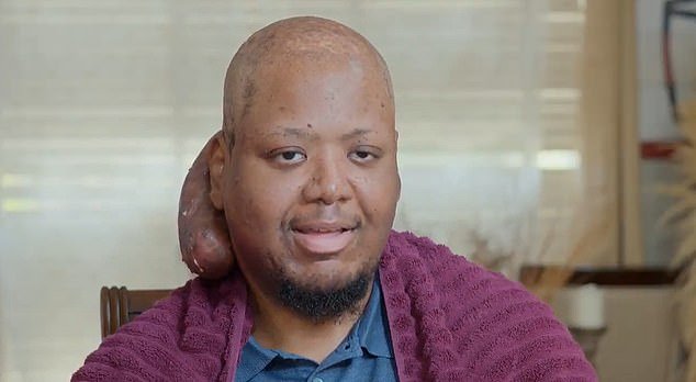 Arlin, 33, from California, had a growth on the back of his head for more than a decade